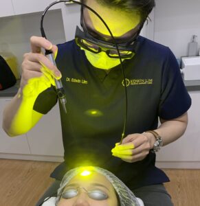 Active Acne Laser Treatment For Face - Yellow Laser Singapore