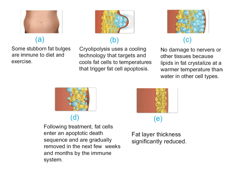 Cryolipolysis for Slimming