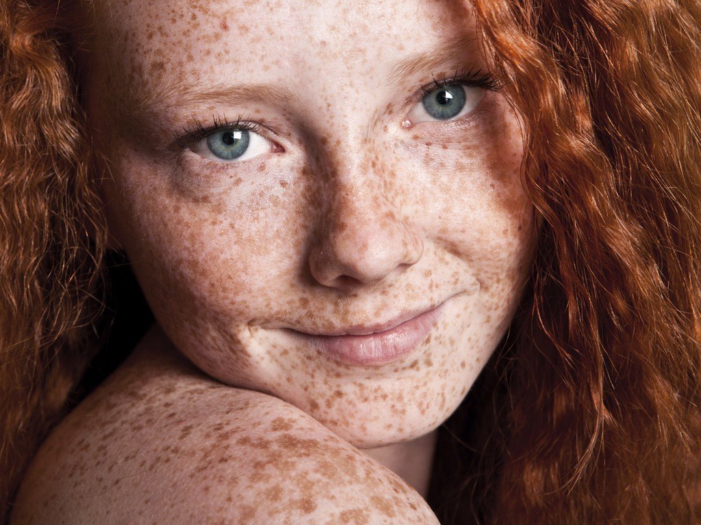 Pigmentation and Freckles