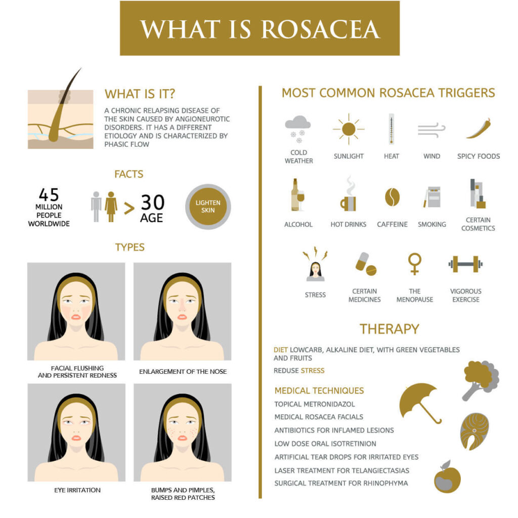 Causes of Rosacea