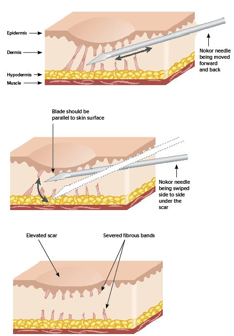 Subcision