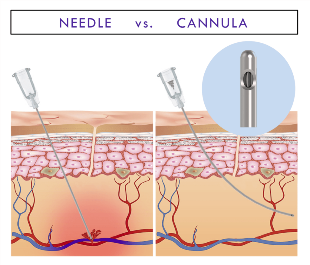 Needle vs Cannula