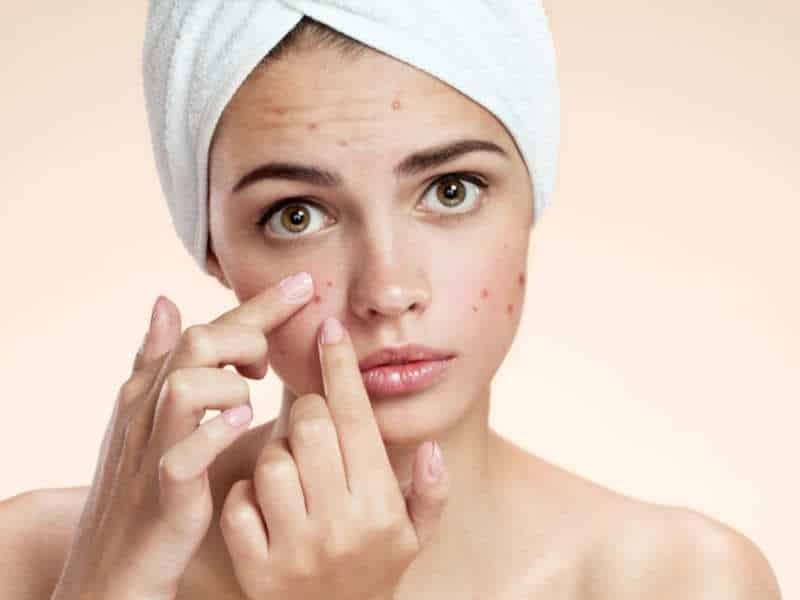 Roaccutane – The Miracle Acne Cure? - Edwin Lim Medical Aesthetic Clinic