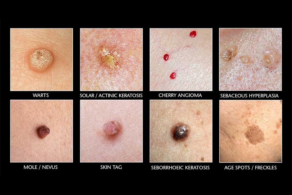 Laser Mole And Skin Tag Removal Singapore Edwin Lim Medical Aesthetic