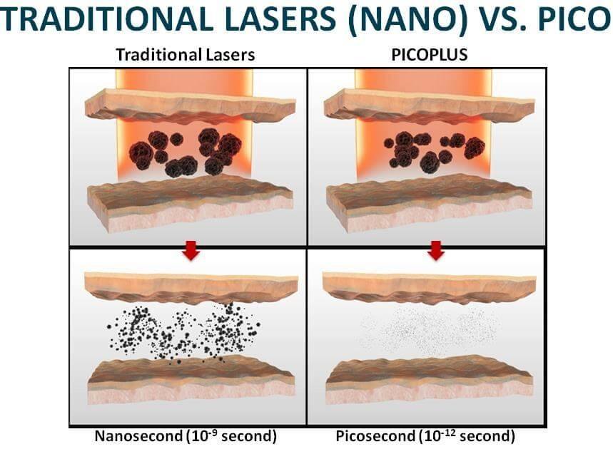 Traditional lasers vs Pico laser