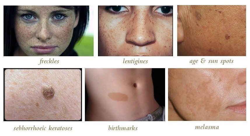 Mole and skin tags images