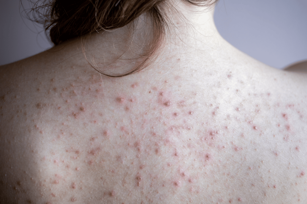 Back Acne And Body Acne Treatment Guide Singapore Edwin Lim Medical 