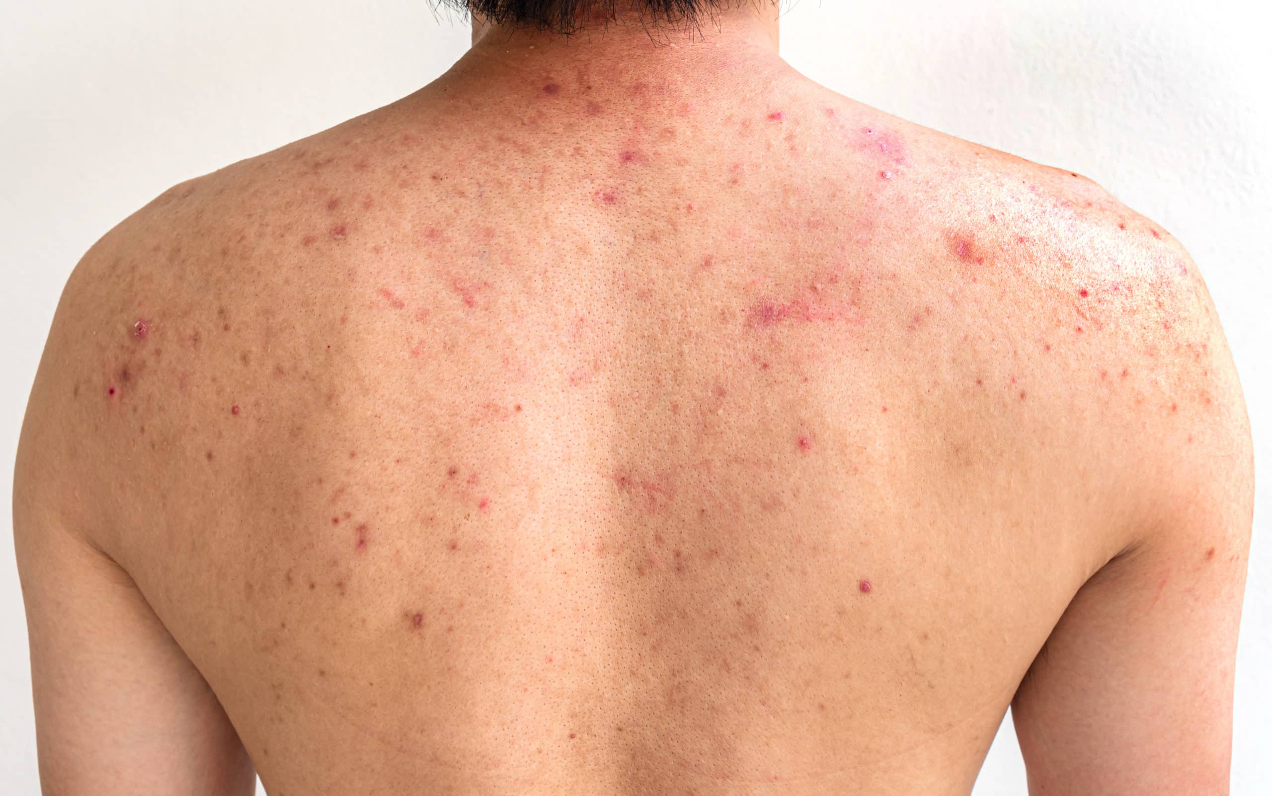 Back Acne And Body Acne Treatment Guide Singapore Edwin Lim Medical 