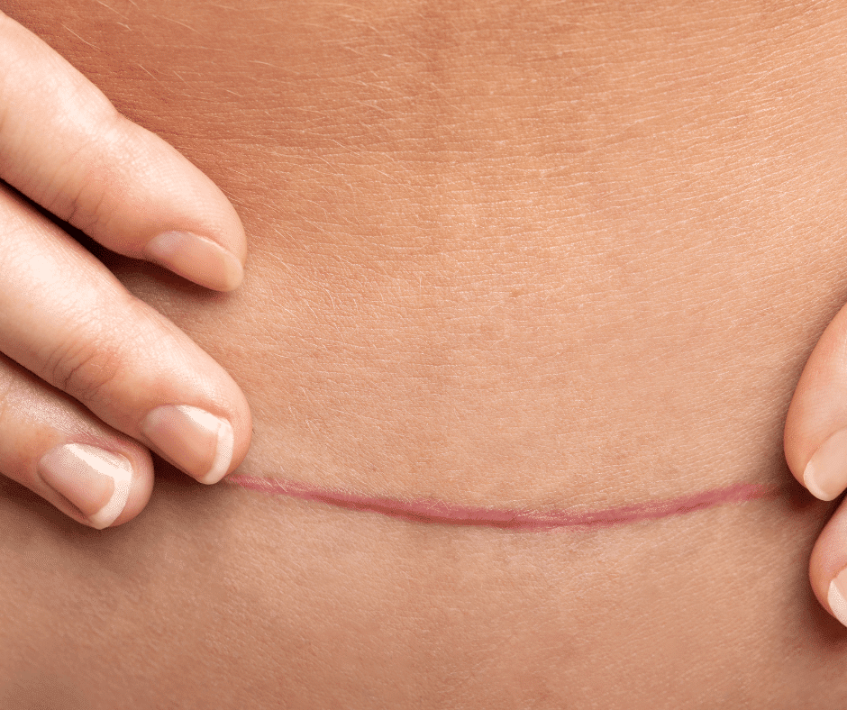 Cesarean C-Section Scar Removal Singapore - Edwin Lim Medical Aesthetic  Clinic